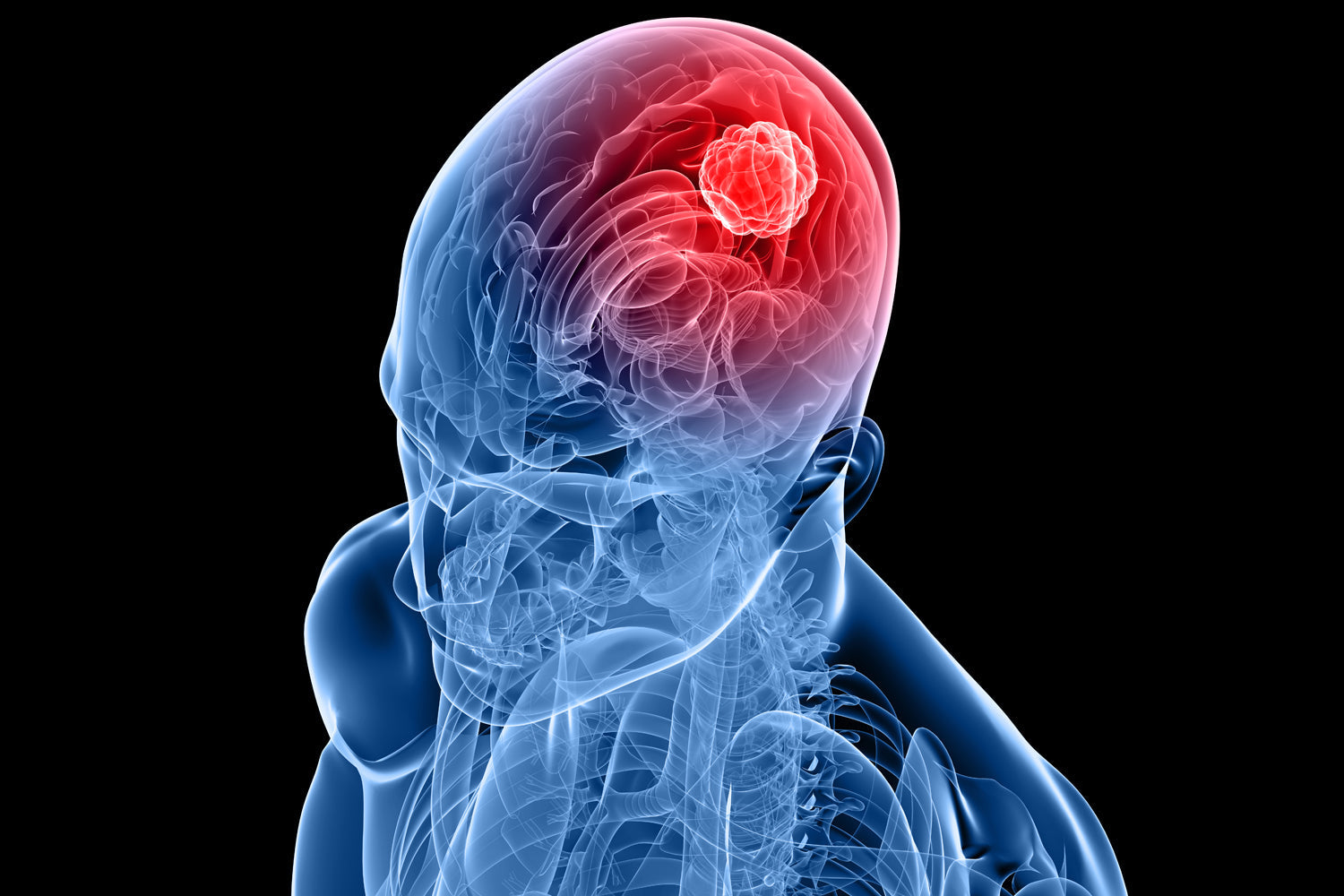 Molecular Hydrogen and Glioblastoma