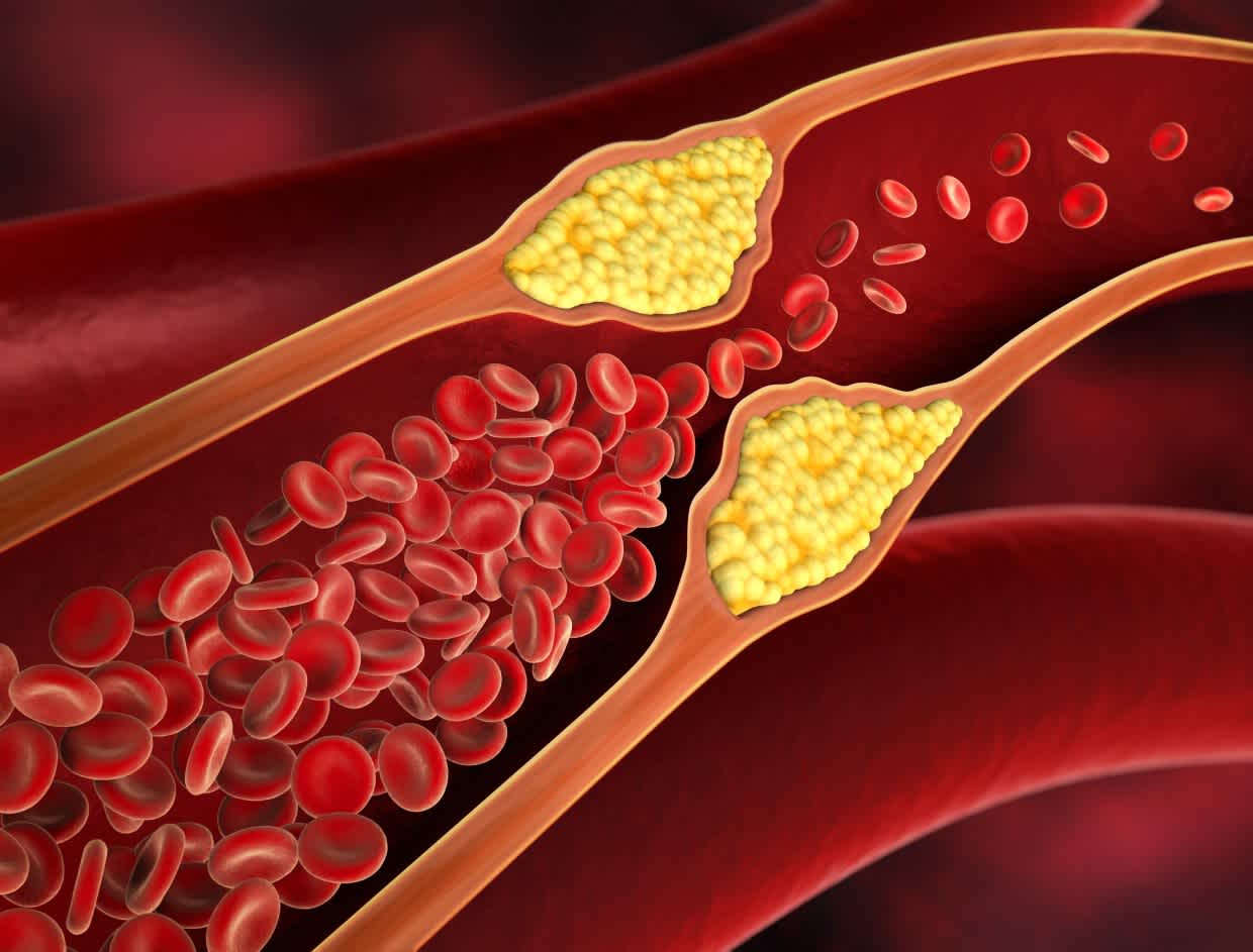 Molecular Hydrogen and High Cholesterol