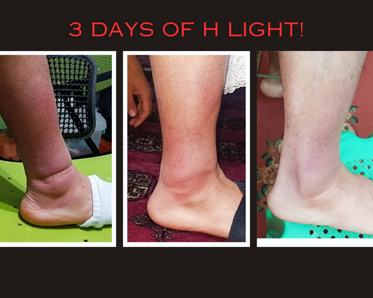 Accelerate Healing from Sprains with H Light Red Light Therapy Mats